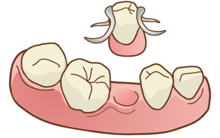 インプラントと入れ歯の違い